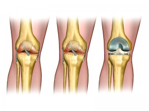 Knee Surgeon Los Angeles