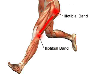 What are the Best Treatments for Iliotibial Band Syndrome?