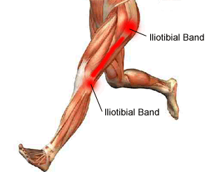 Physiotherapy in Winnipeg for Knee - Iliotibial Band Syndrome