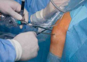 Knee Surgeon Los Angeles