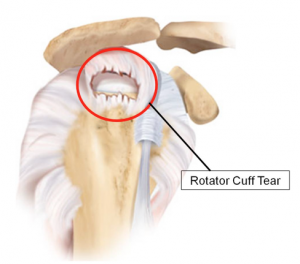 torn rotary cup