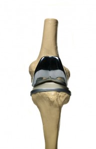 Knee Replacement Surgeon Los Angeles