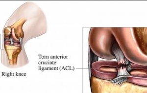 ACL tear