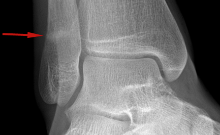 An Overview of Stress Fractures of the Leg