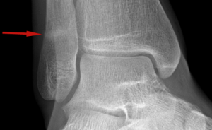 stress fracture2