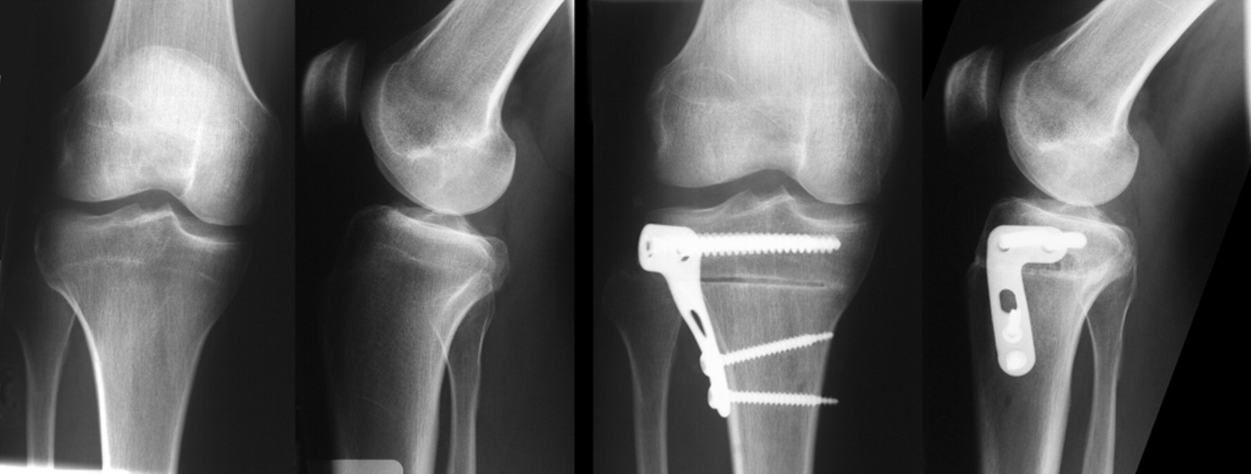 High Tibial Osteotomy Procedure For Knee Arthritis