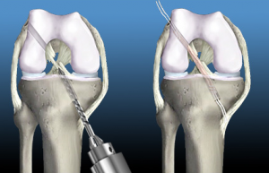 ACL repair