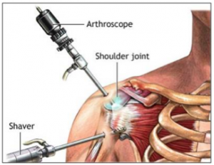 Shoulder Arthroscopy