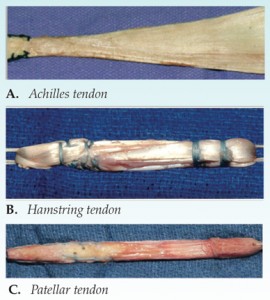 anterior-cruciate-ligament-acl-reconstruction-graft-selection-osuv6n2-3-2coljpg