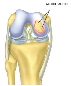 Knee Surgery Beverly Hills & Los Angeles
