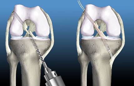 ACL Surgeon Los Angeles