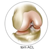 ACL Surgeon Los Angeles