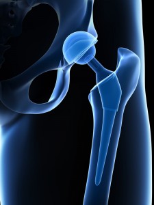 Hip Replacement Los Angeles