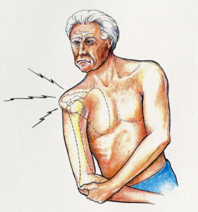 shoulder instability pain