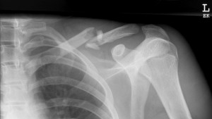 Clavicle-Fracture-Type-B